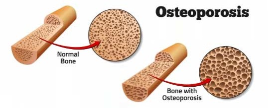 Osteoporosis-538x218